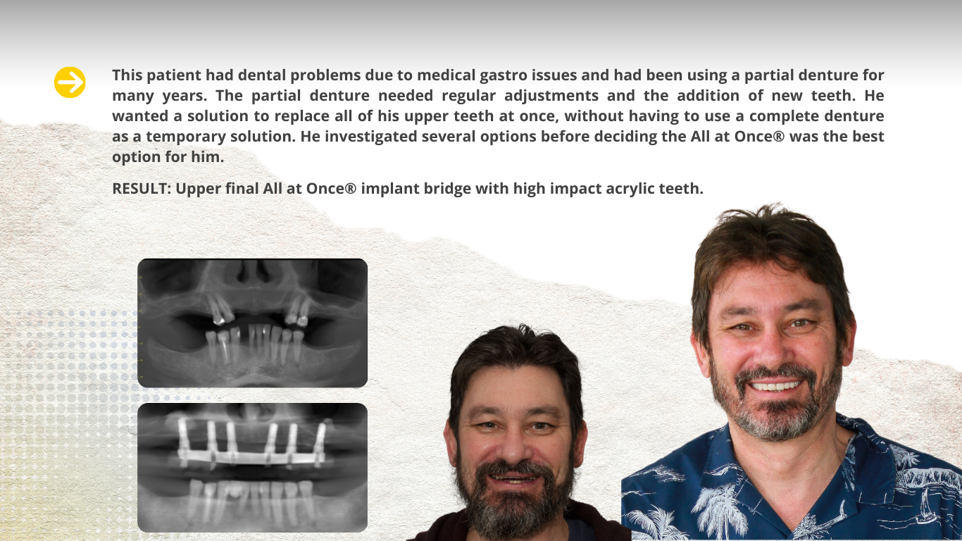 Upper Implant Bridge with Acrylic Teeth at Bayside Dental Specialist (2)